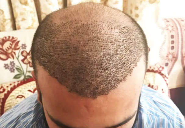 Get To Know The Main Techniques And Importance of Hair Transplant Cost in Jaipur