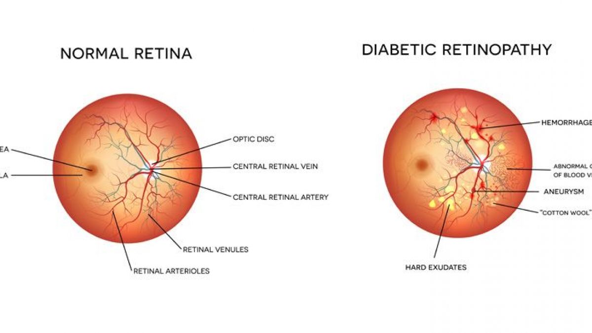 Diabetic Retinopathy | Bharti Eye Foundation