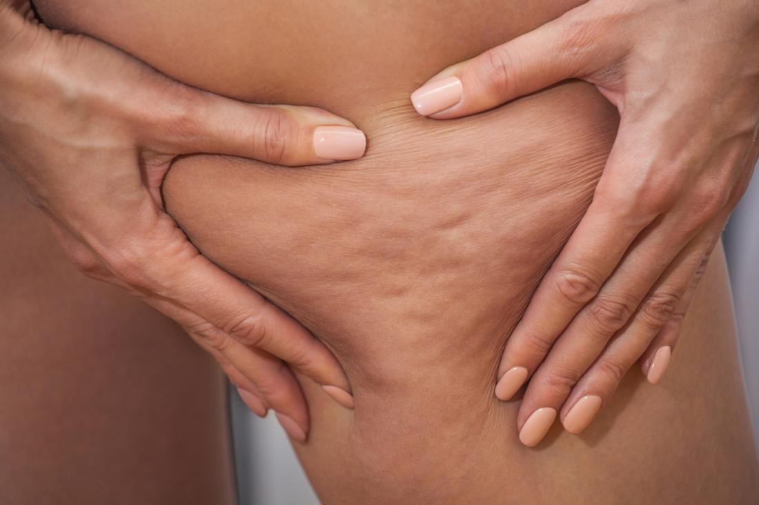 Cellulite Treatment: How to Get Rid of Cellulite