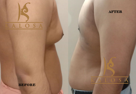 Gynecomastia Surgery in Delhi: Get Flatter Chest at Affordable Cost