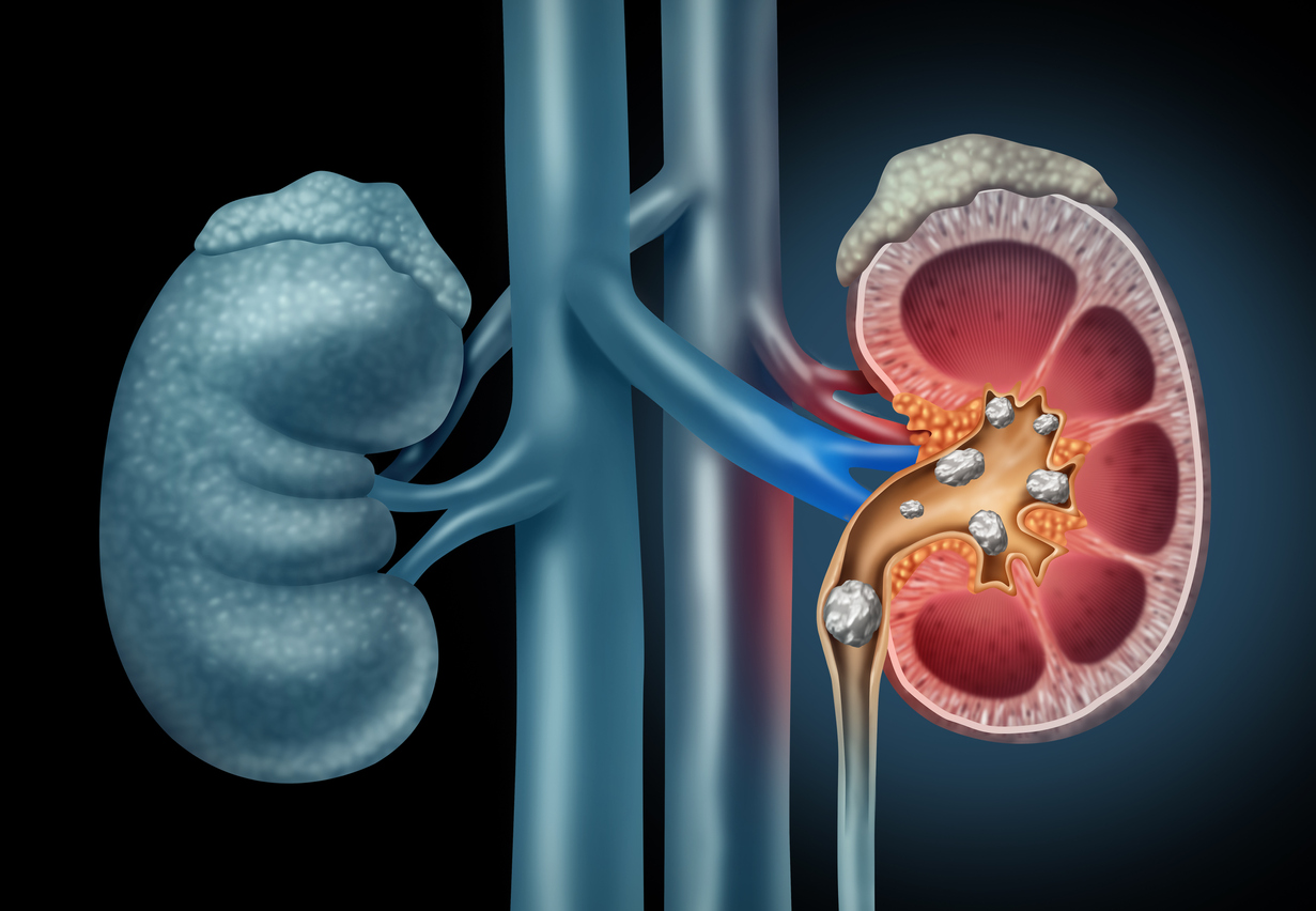 Breaking Down Kidney Stones Treatment: A Comprehensive Guide from Diagnosis to Recovery
