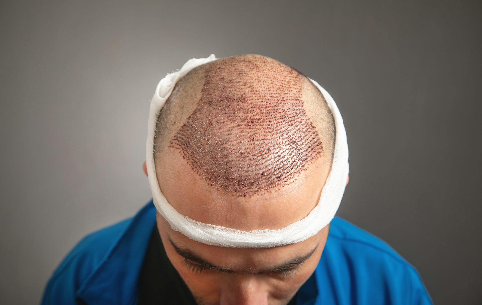 The Importance of Scalp Assessment Before a Hair Transplant