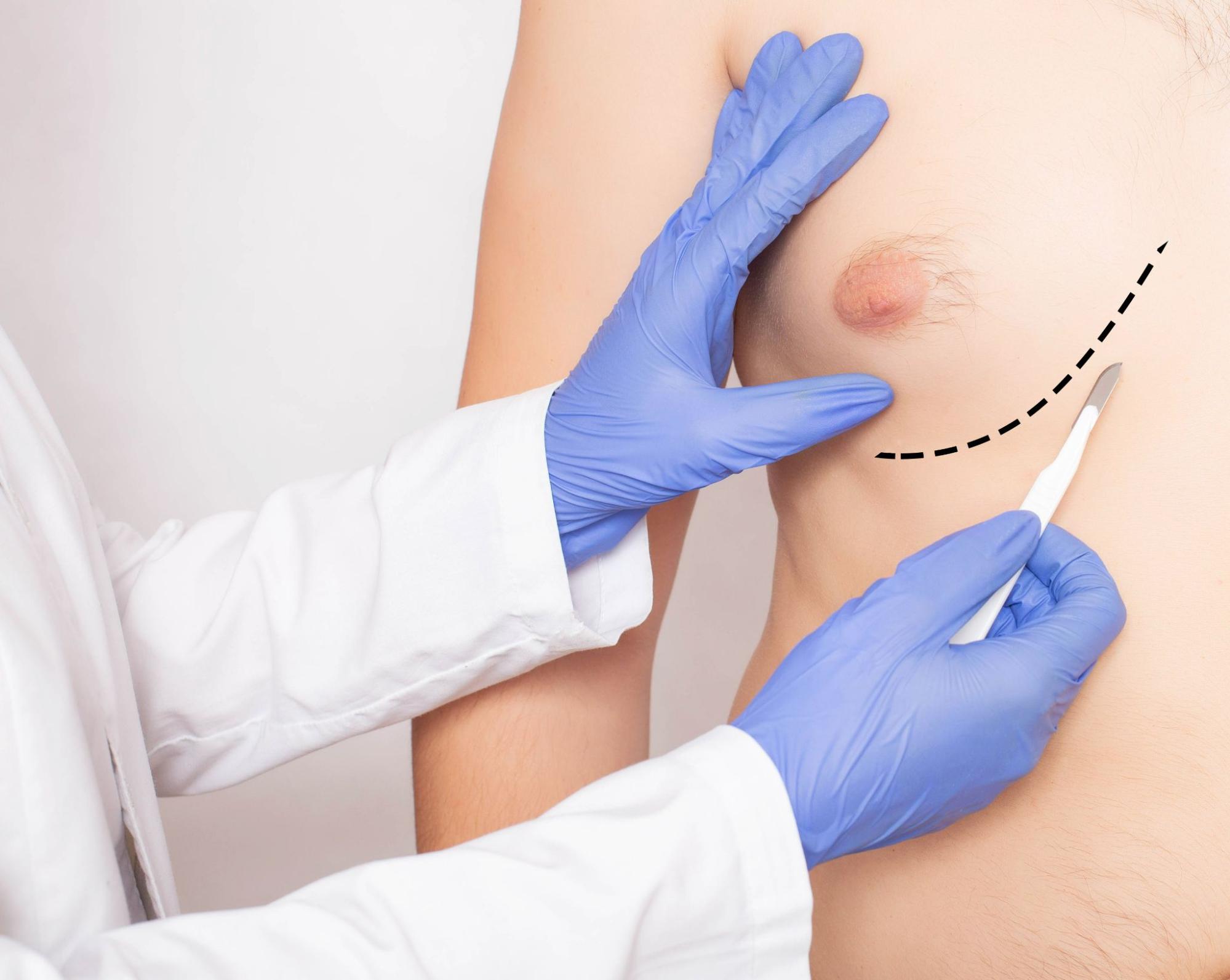 Are Natural Remedies for Gynecomastia Effective?
