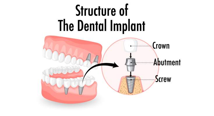 All-on-Four Dental Implants Explained: What Every Patient Should Know