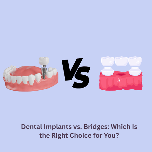 Dental Implants vs. Bridges: Which Is the Right Choice for You?