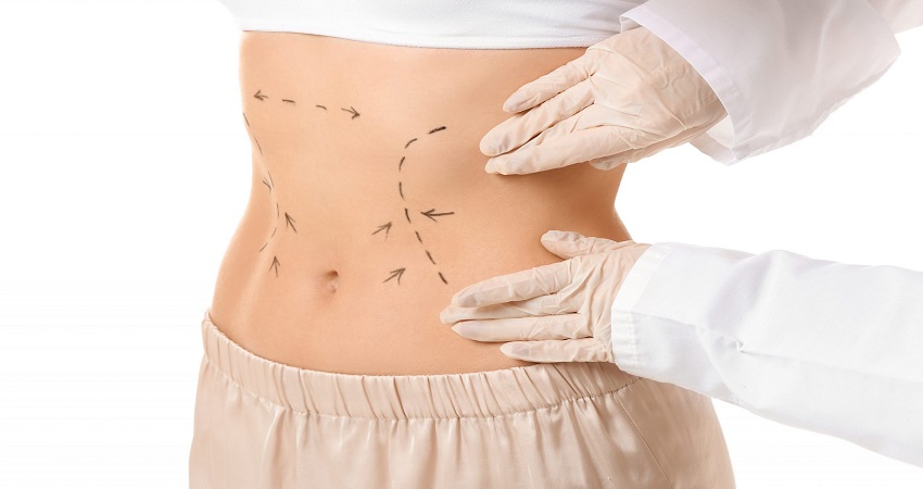 Tummy Tuck in Dubai: How to Prepare for Your Procedure