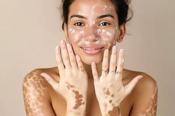 6 Pitfalls Vitiligo Patients Follow Before Receiving Homeopathy
