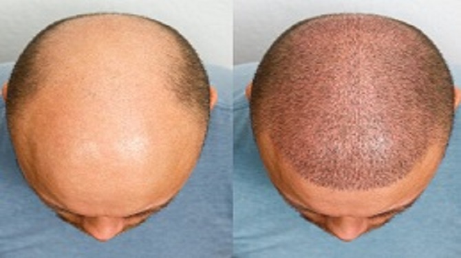 Practical steps for hair transplantation in Riyadh, from start to recovery