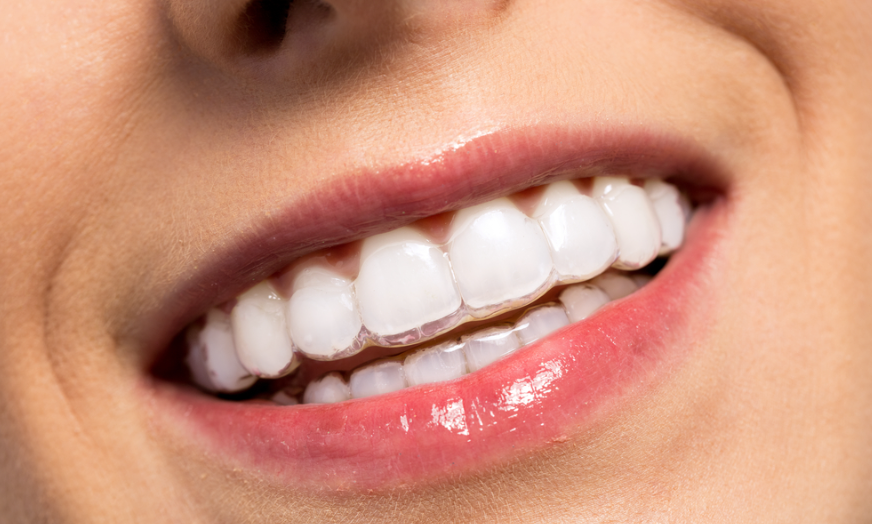 Best Invisalign Dentist NYC