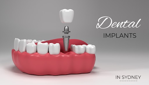 Understanding Dental Implant Pricing in Sydney