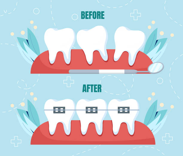 10 Questions to Ask Your Orthodontist Before Getting Braces!