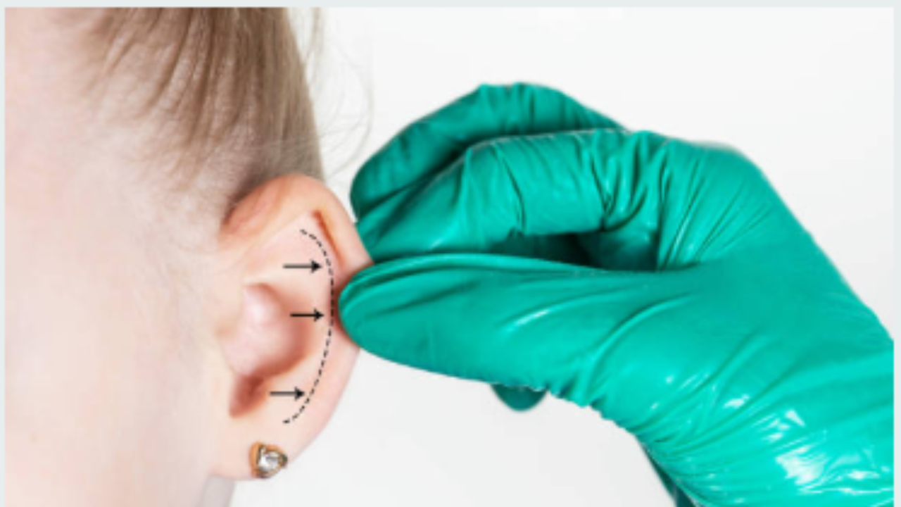 Oorlel correctie in 2026: hoe fillers oorlellen herstellen zonder operatie