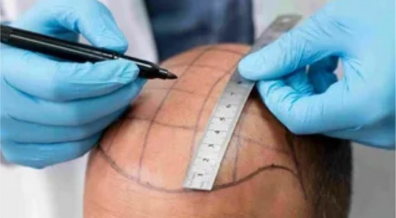 Navigating the Dust: Scalp Hygiene After a Hair Transplant in Riyadh