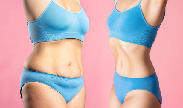Why Riyadh Residents Choose Liposuction for Lasting Contours