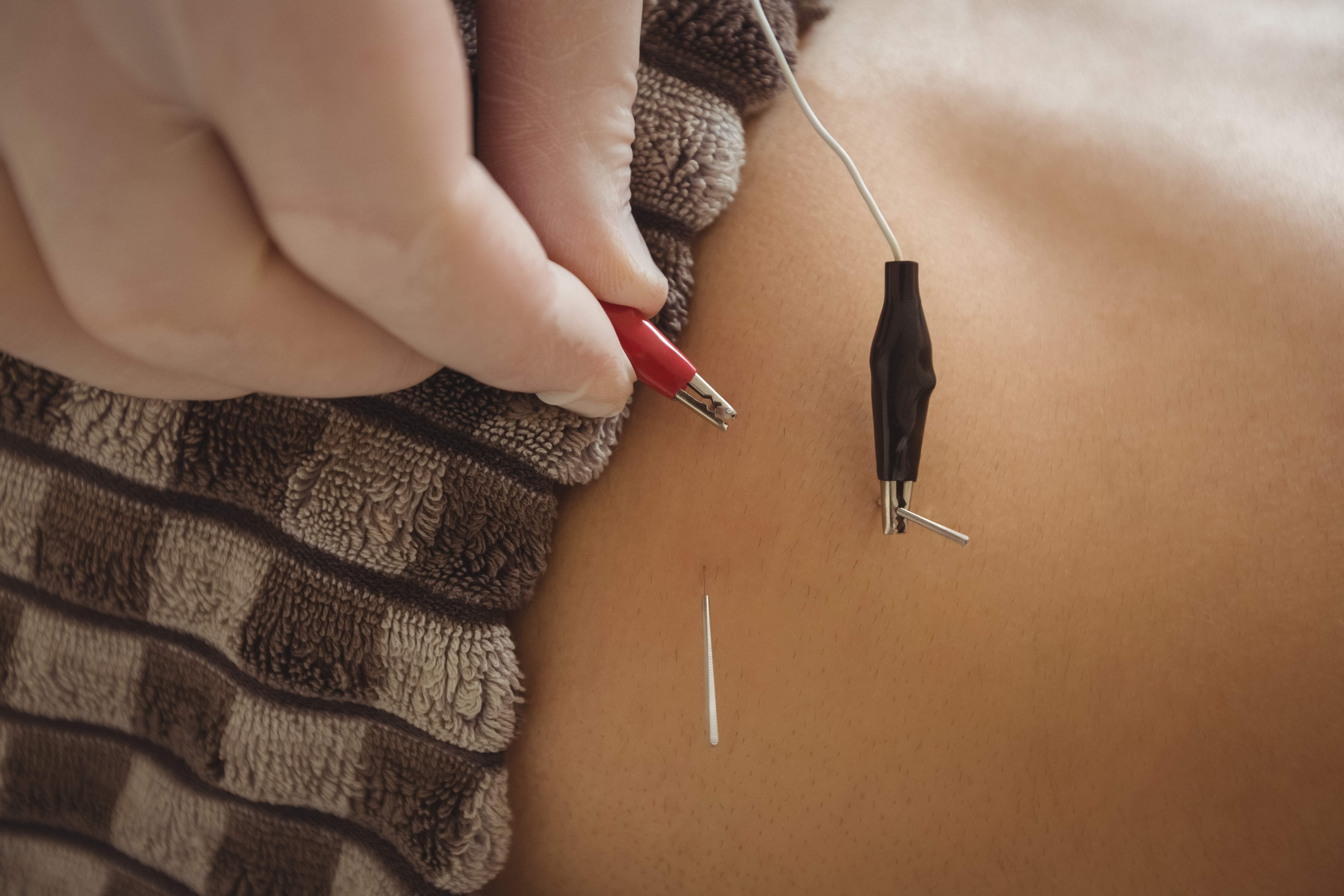 Top 7 Reasons Newport Beach Residents Are Moving Towards Acupuncture for Pain Relief