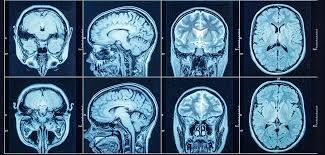 CT Scan Cost in Bangalore: A Complete Guide by Ecotown