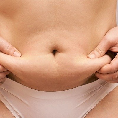 Can Vaser 4D Liposuction Help with Weight Loss?