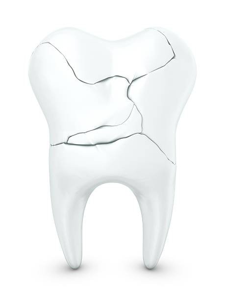 Tooth Fracture Treatment in Pakistan: Dental Care Standards, Safety, and Modern Practices