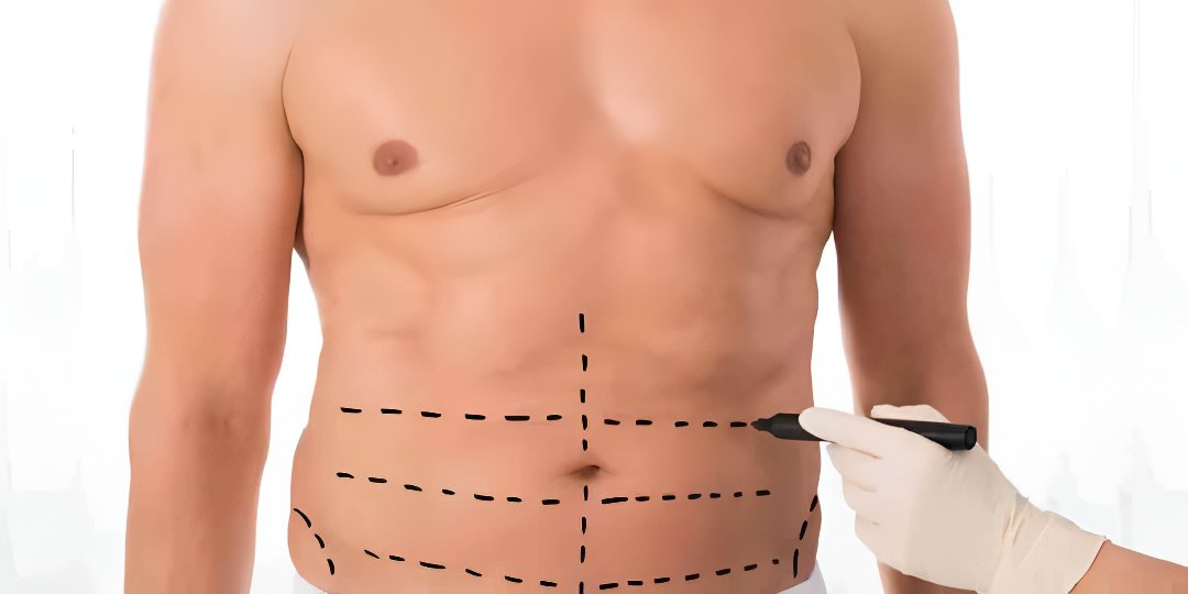 The Ultimate Guide to Liposuction in Islamabad