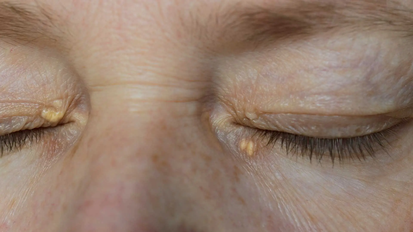 What Are the Most Effective Eyelid Xanthelasma Removal Techniques?