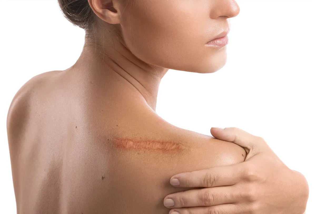 Can Surgical Scar Revision Help Achieve a Flawless Skin Look?