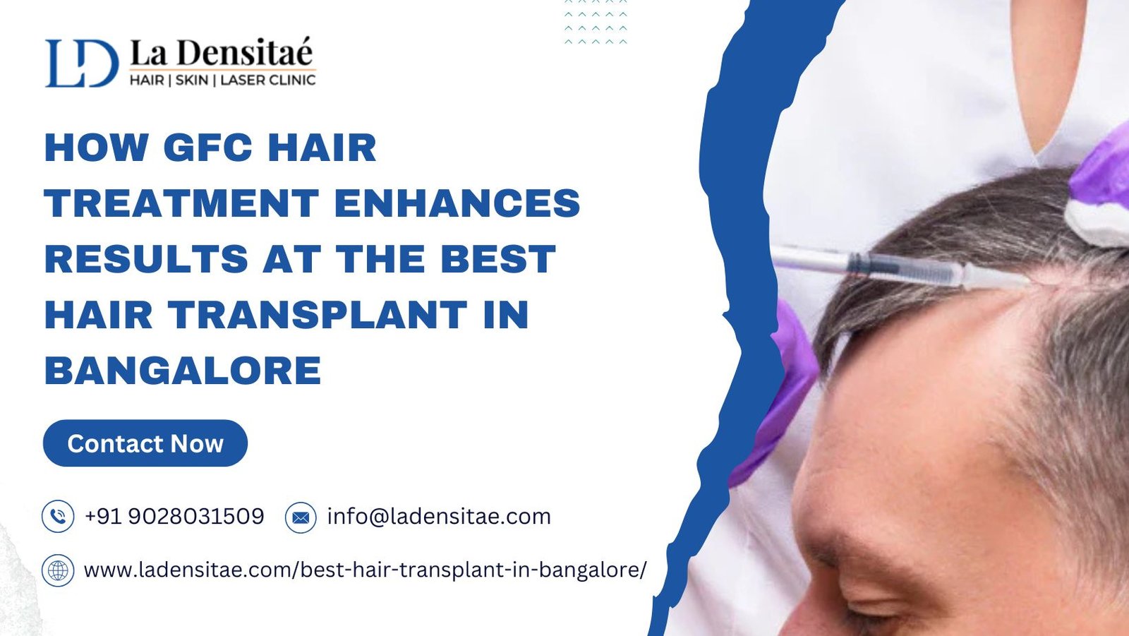 How GFC Hair Treatment Enhances Results at the Best Hair Transplant in Bangalore