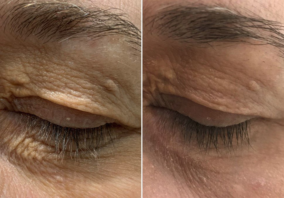 Clinics Worth Considering for Eyelid Xanthelasma Removal