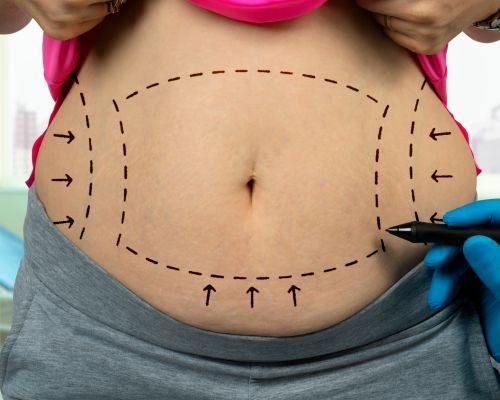 How much fat can be removed during liposuction?