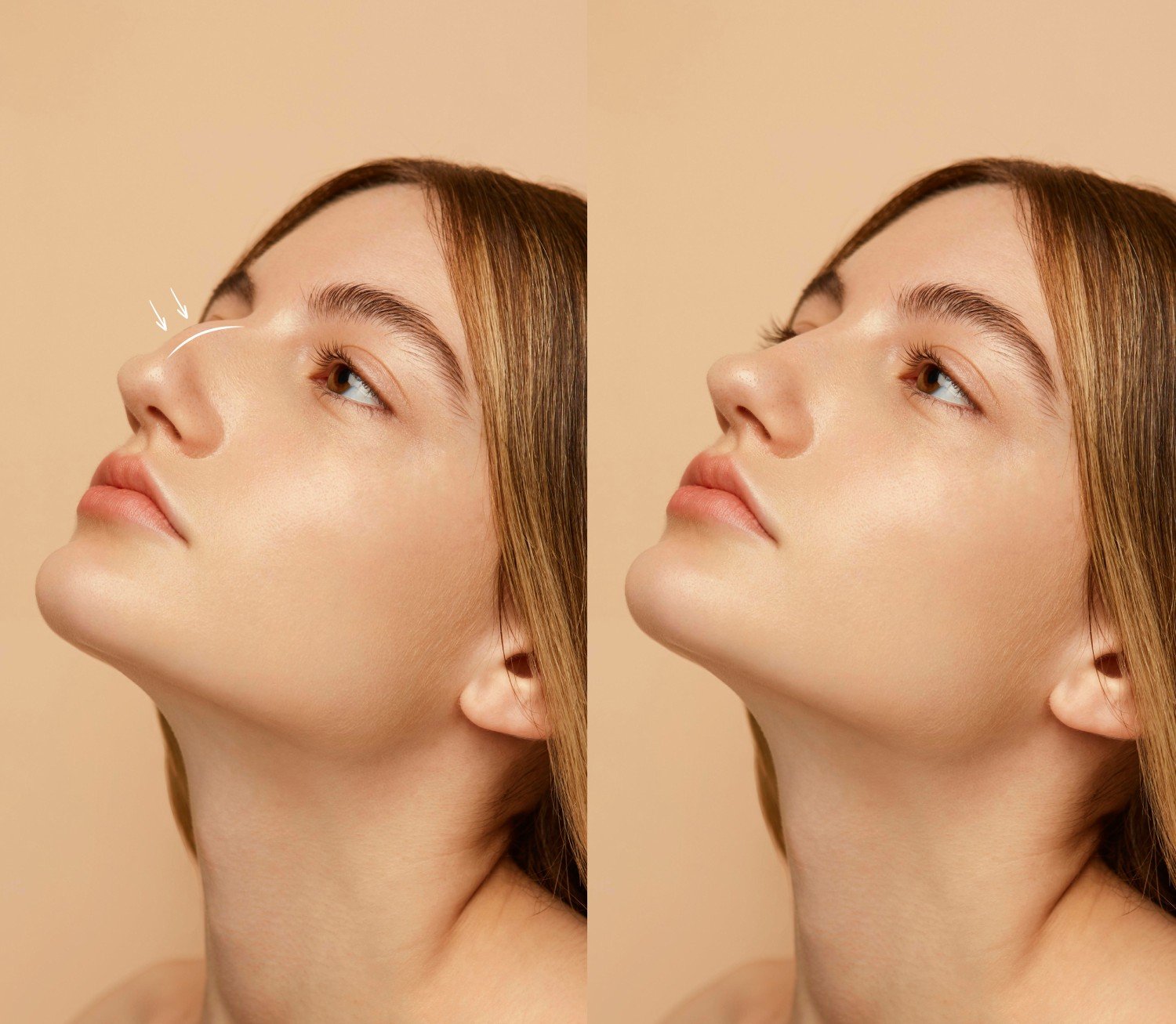 7 Realities of Rhinoplasty Before and After Transformation