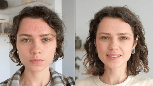 Why Regular Facials Support Better Skin Health