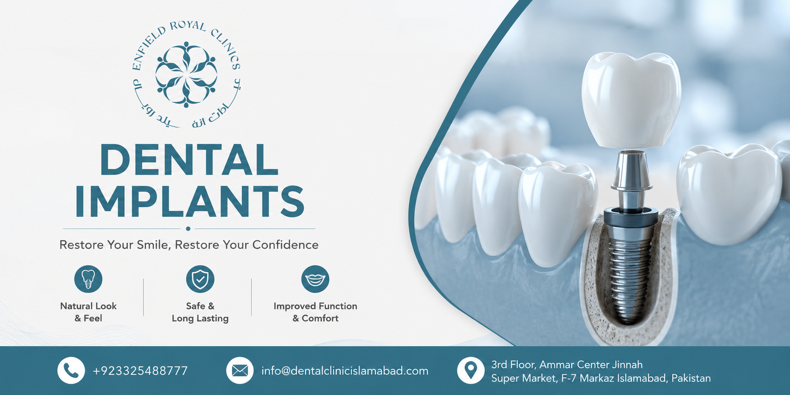 Everything About the Best Dental Implants in Islamabad