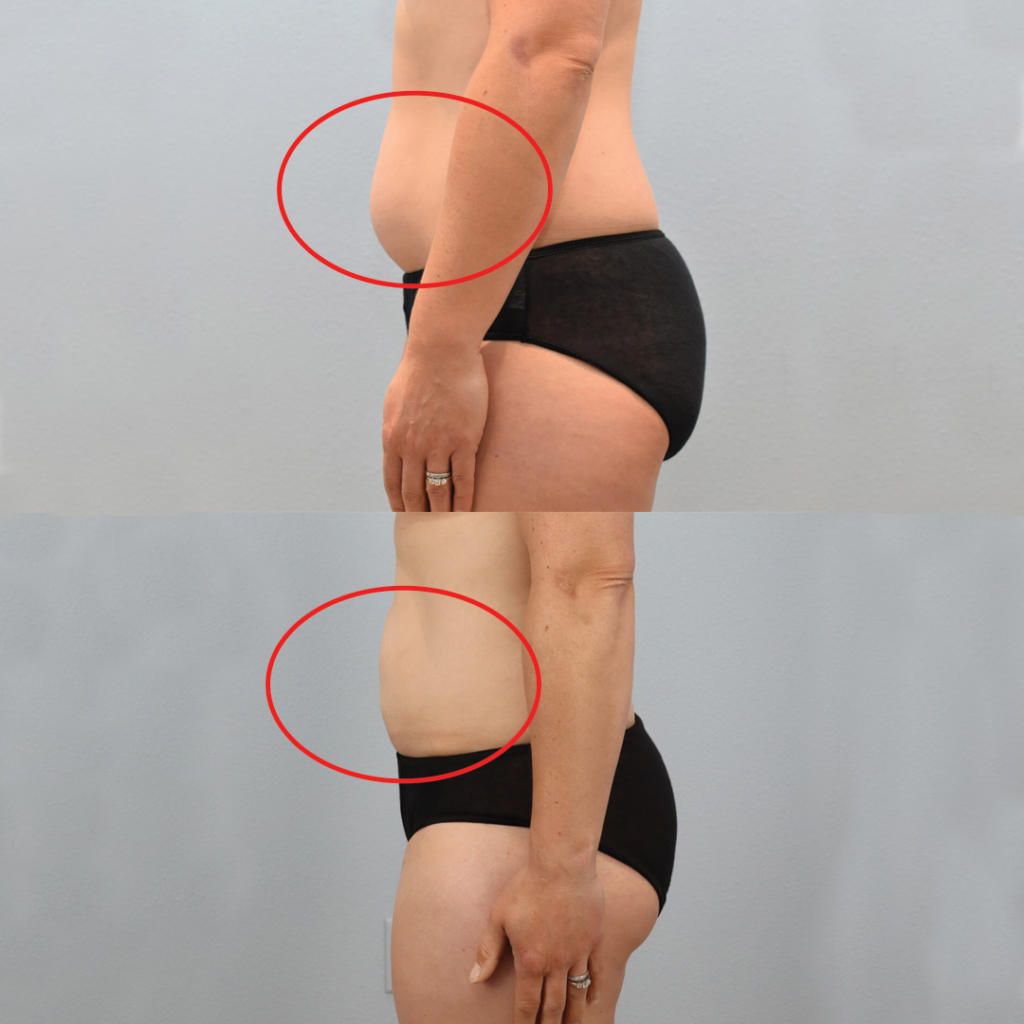 Liposuction Before and After Your Complete Journey Guide