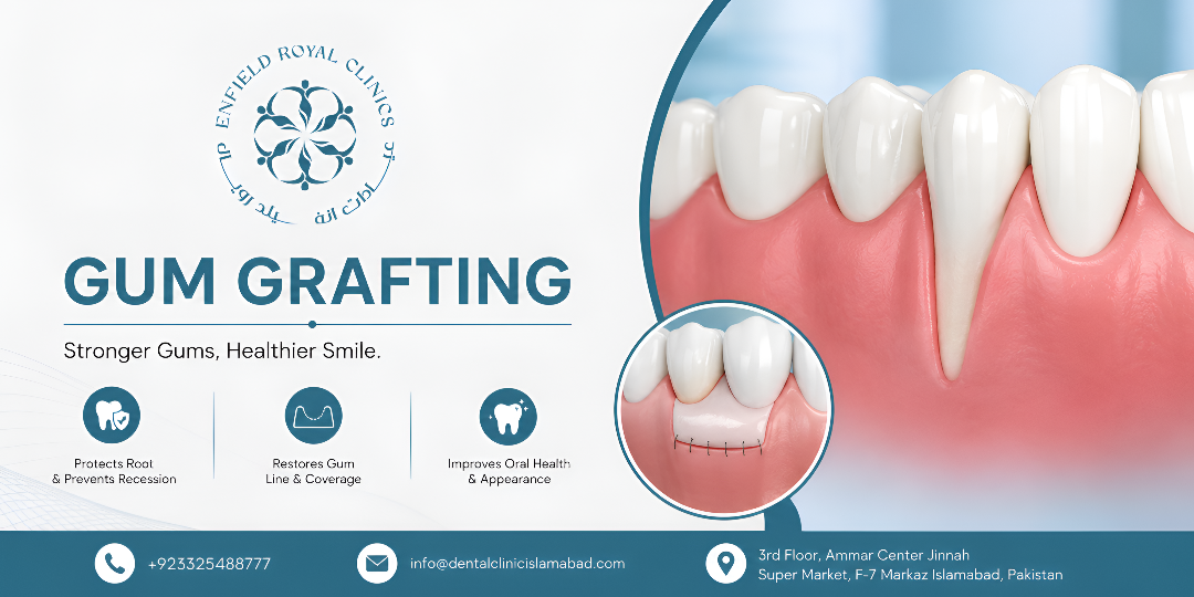 Gum Grafting in Islamabad for Receding Gum Correction