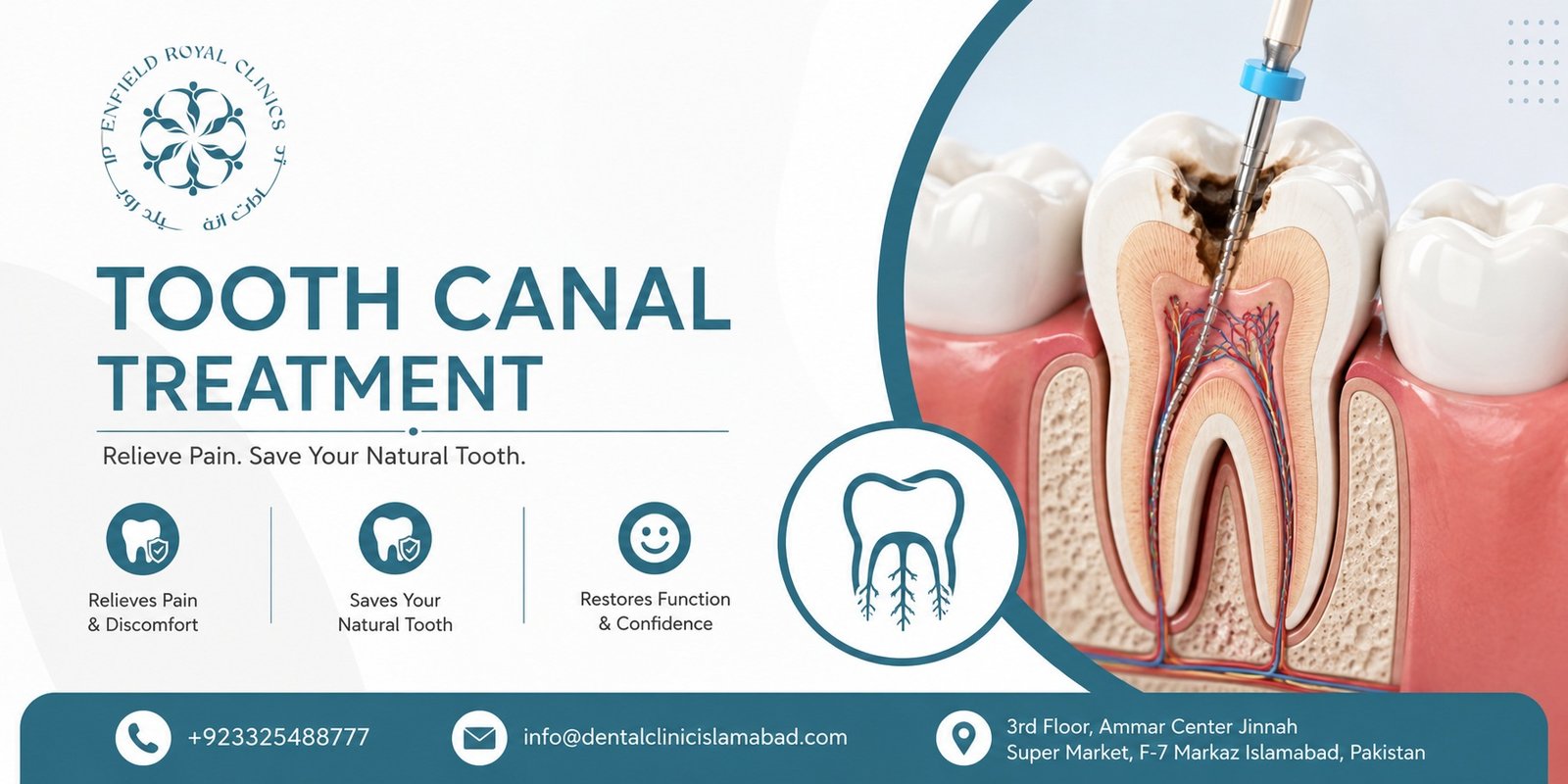 Tooth Canal Treatment in Islamabad for Dental Relief