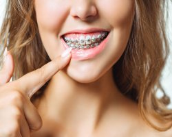 Do I Need Braces? Signs You Should See an Orthodontist?