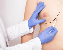 Are Natural Remedies for Gynecomastia Effective?
