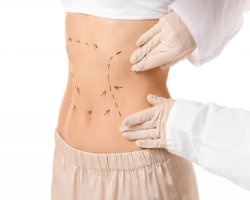 Tummy Tuck in Dubai: Cost Breakdown and Financing Options