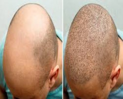 Best Hair Transplant Surgeons in Riyadh: What to Know Before You Book