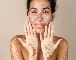 6 Pitfalls Vitiligo Patients Follow Before Receiving Homeopathy