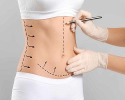 Is Liposuction a Safe Option for Weight Loss in Islamabad?