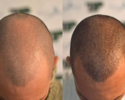 Transform Your Look with Scalp Micropigmentation in Islamabad
