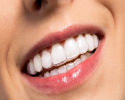Best Invisalign Dentist NYC
