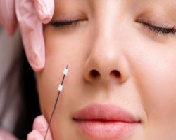 Wat is een draadlift? Alles wat je moet weten over deze huidverjongende behandeling