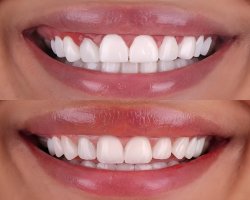 Gum Recontouring Treatment: A Modern Solution for a Balanced, Confident Smile