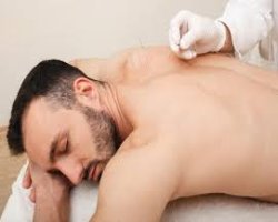 Dry Needling Therapy