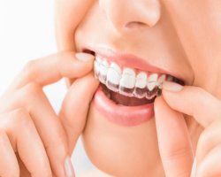 Advanced Orthodontic Freedom with Teeth Aligners in Islamabad