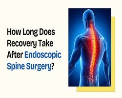 How Long Does Recovery Take After Endoscopic Spine Surgery?