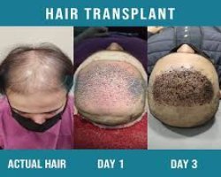 Can the Best Hair Transplant in Lahore Give Natural and Permanent Hair Growth?