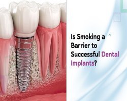 Is Smoking a Barrier to Successful Dental Implants?