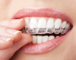  Advanced Orthodontic Care for a Confident and Healthy Smile Teeth Aligners in Pakistan: